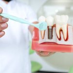 how long do dental implants last