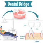 benefits of dental bridges restore your smile and function