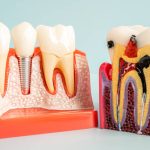 are dental implants better than root canals