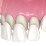 how to make composite veneers last longer