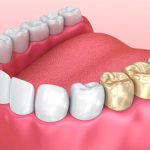 what is a dental crown everything you need to know